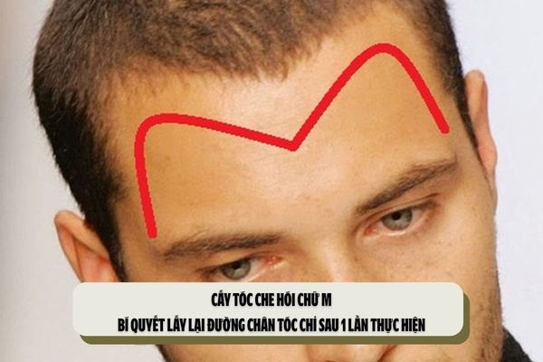 Cấy tóc che hói chữ M: Bí quyết lấy lại đường chân tóc chỉ sau 1 lần thực hiện