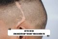 Cấy tóc che sẹo: Công nghệ mới giúp “hồi sinh” vùng da không tóc
