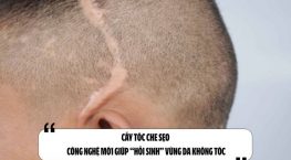 Cấy tóc che sẹo: Công nghệ mới giúp “hồi sinh” vùng da không tóc