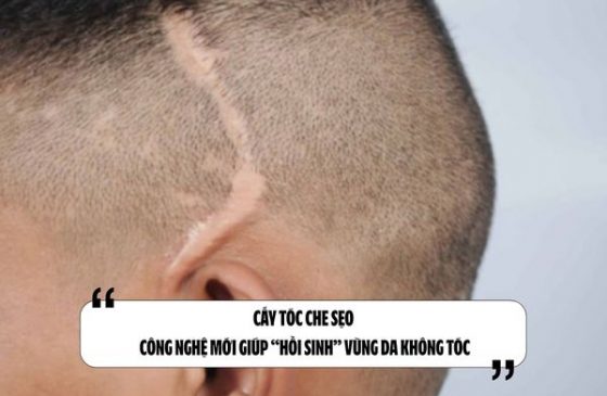 Cấy tóc che sẹo: Công nghệ mới giúp “hồi sinh” vùng da không tóc