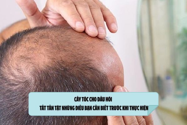 Cấy tóc cho đầu hói – Tất tần tật những điều bạn cần biết trước khi thực hiện