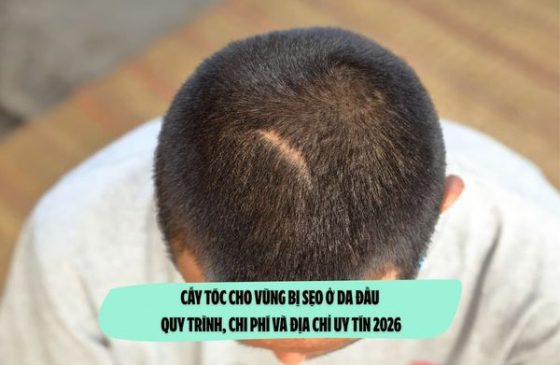 Cấy tóc cho vùng bị sẹo ở da đầu: Quy trình, chi phí và địa chỉ uy tín 2026