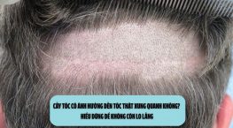 Cấy tóc có ảnh hưởng đến tóc thật xung quanh không? Hiểu đúng để không còn lo lắng