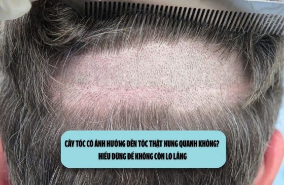 Cấy tóc có ảnh hưởng đến tóc thật xung quanh không? Hiểu đúng để không còn lo lắng