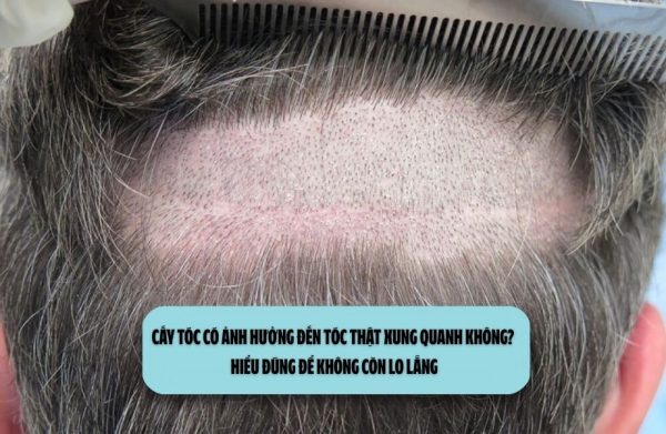 Cấy tóc có ảnh hưởng đến tóc thật xung quanh không? Hiểu đúng để không còn lo lắng
