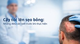 Cấy tóc lên sẹo bỏng: Những điều cần biết trước khi thực hiện