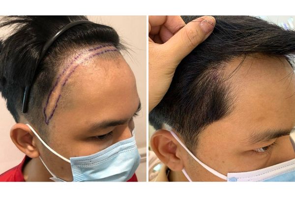 Cấy tóc che sẹo: Công nghệ mới giúp “hồi sinh” vùng da không tóc