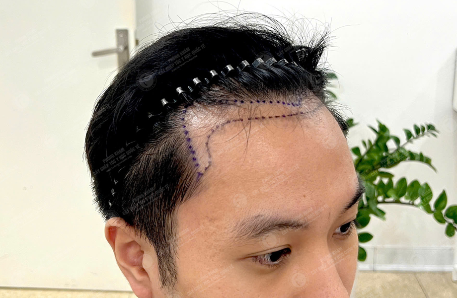 Phan Tùng Lâm - Cấy tóc đường chữ M 2
