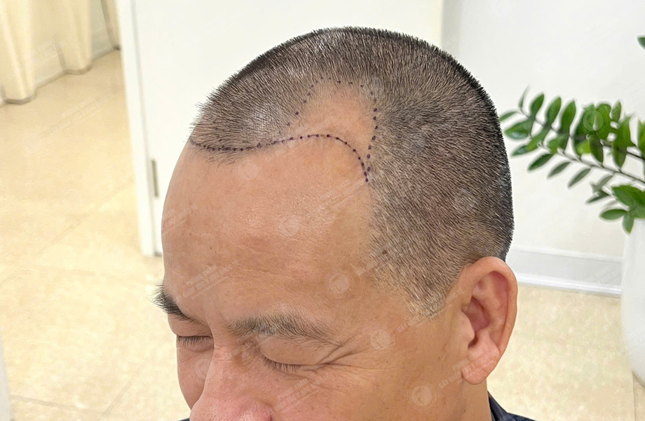 Trần Văn Toàn - Cấy tóc đường chữ M 2