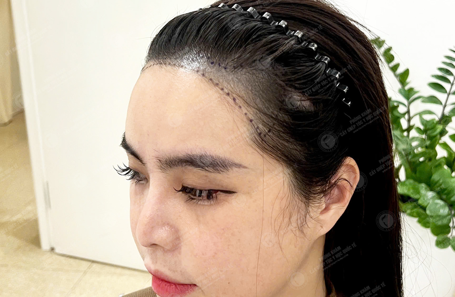 Huỳnh Bảo Ngân - Cấy tóc đường chữ M 2