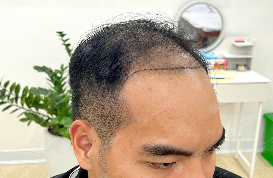 Nguyễn Văn Sơn - Cấy tóc đường chữ M 2
