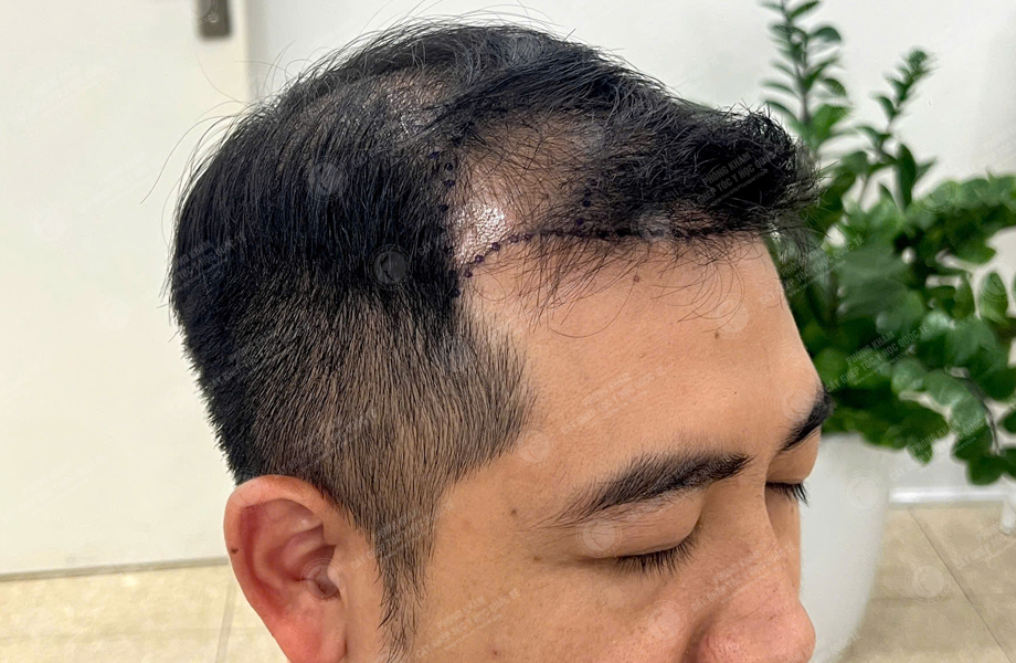 Lý Hoài Nam - Cấy tóc đường chữ M 2