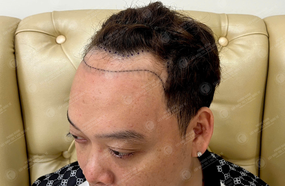 Nguyễn Quốc Đoàn - Cấy tóc đường chữ M 3