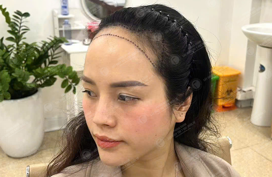 Nguyễn Thu Trà - Cấy tóc đường chữ M 2
