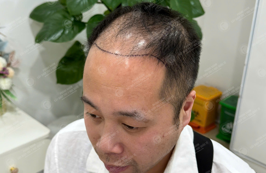Nguyễn Duy Sơn - Cấy tóc đường chữ M 2