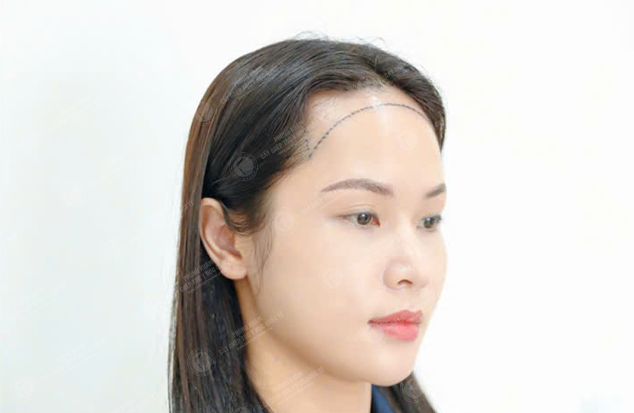 Hoàng Ngọc Linh - Cấy tóc đường chữ M 2