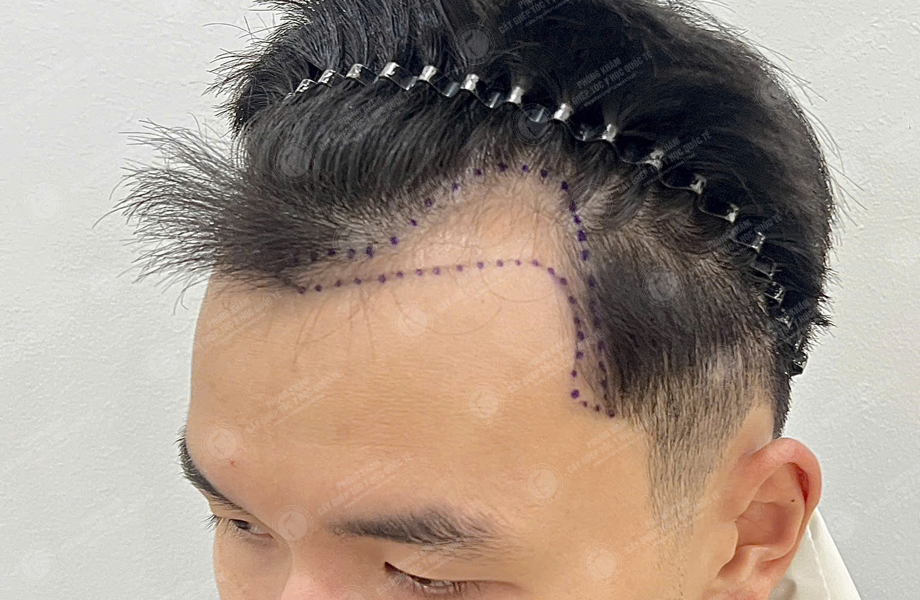 Trần Tuấn Hùng - Cấy tóc đường chữ M 2