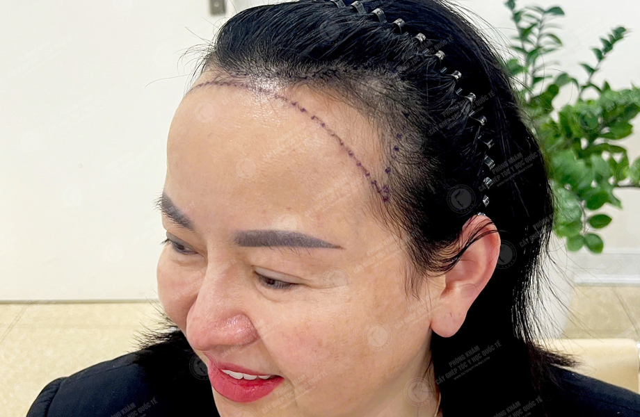 Nguyễn Thị Lan - Cấy tóc đường chữ M 2