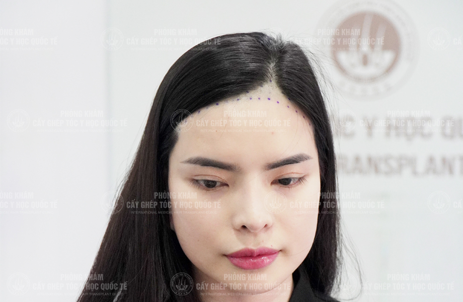 Đỗ Thanh Tuyền - Cấy tóc đường chữ M 2