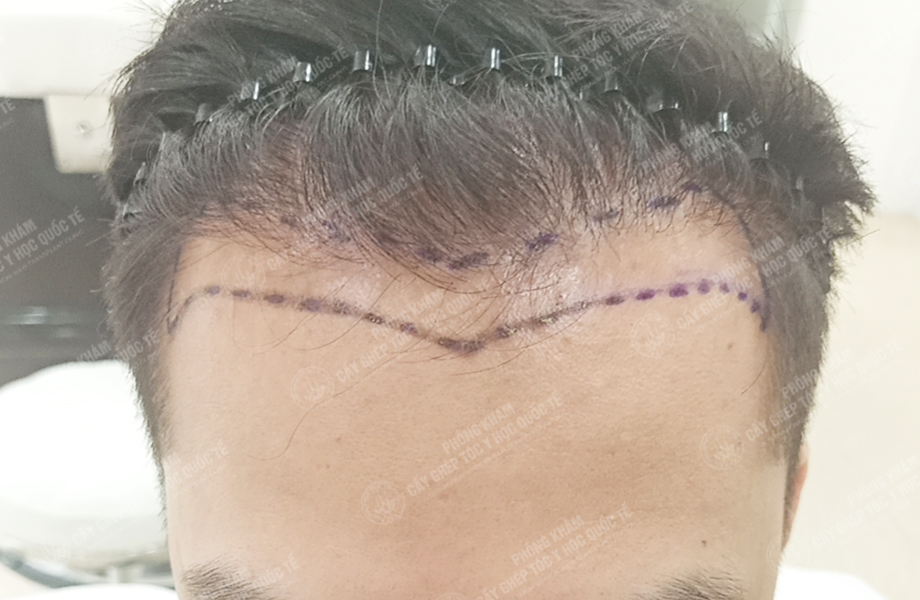 Vũ Quang Nam - Cấy tóc đường chữ M 2