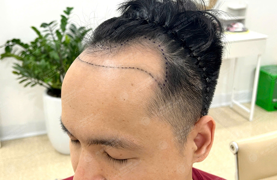 Nguyễn Văn Tùng - Cấy tóc đường chữ M 2