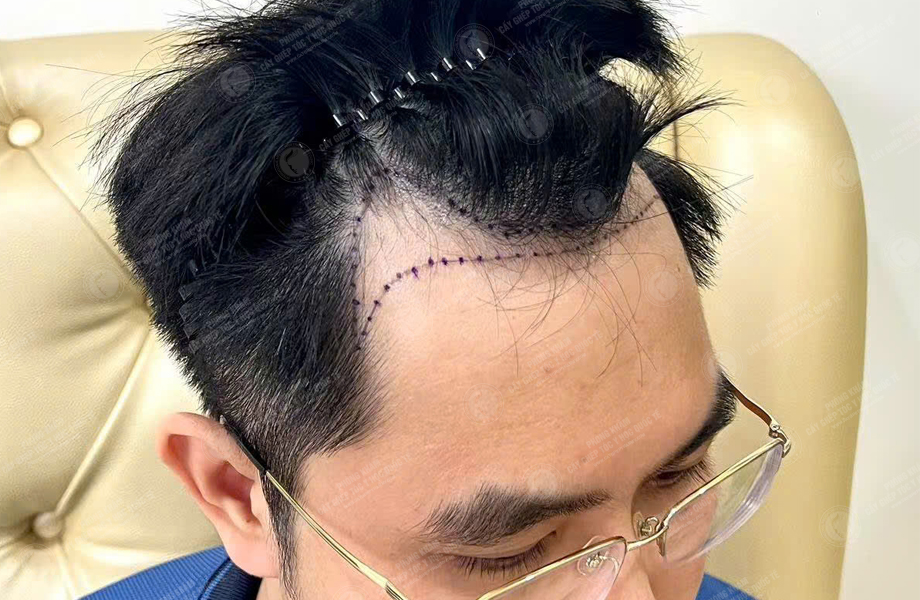 Nguyễn Văn Nam - Cấy tóc đường chữ M 2
