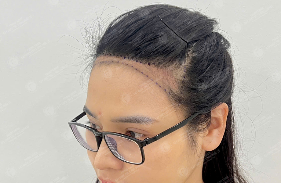 Phạm Thị Trang - Cấy tóc đường chữ M 2