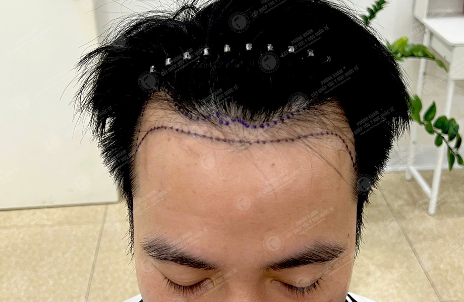 Nguyễn Tiến Hiệp - Cấy tóc đường chữ M 2
