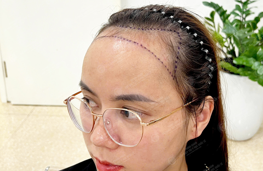 Phạm Thị Huệ - Cấy tóc đường chữ M 2