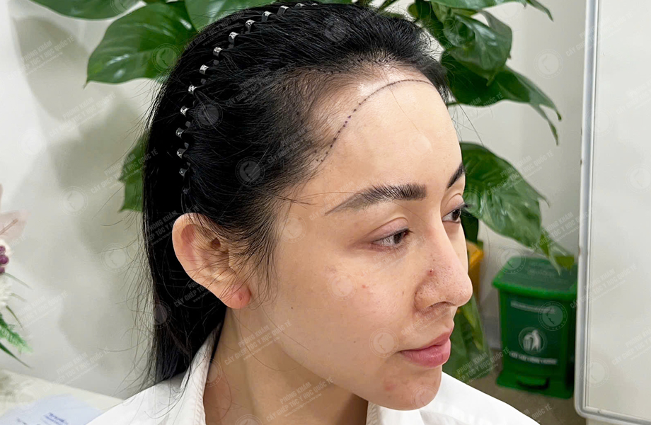 Nguyễn Ngọc Hân - Cấy tóc đường chữ M 2