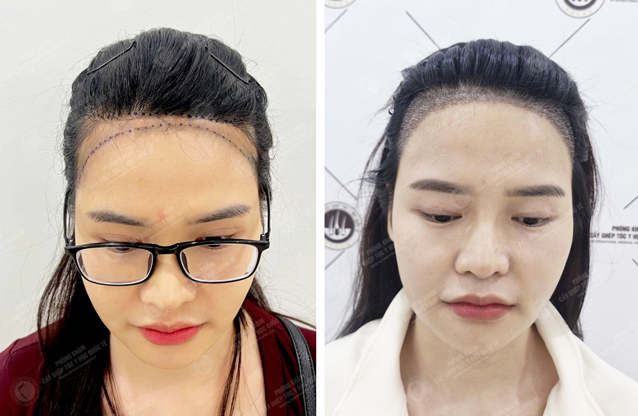  Phạm Thị Trang - Điều chỉnh đường chân tóc 1