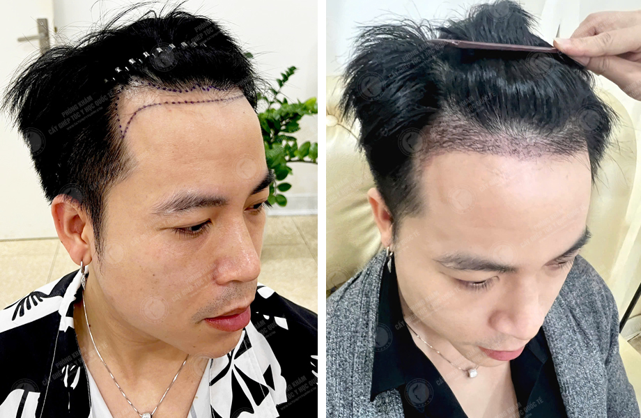  Nguyễn Tiến Hiệp - Cấy tóc đường chữ M 1