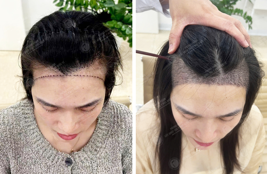  Lê Thị Nhi - Cấy tóc đường chữ M 1
