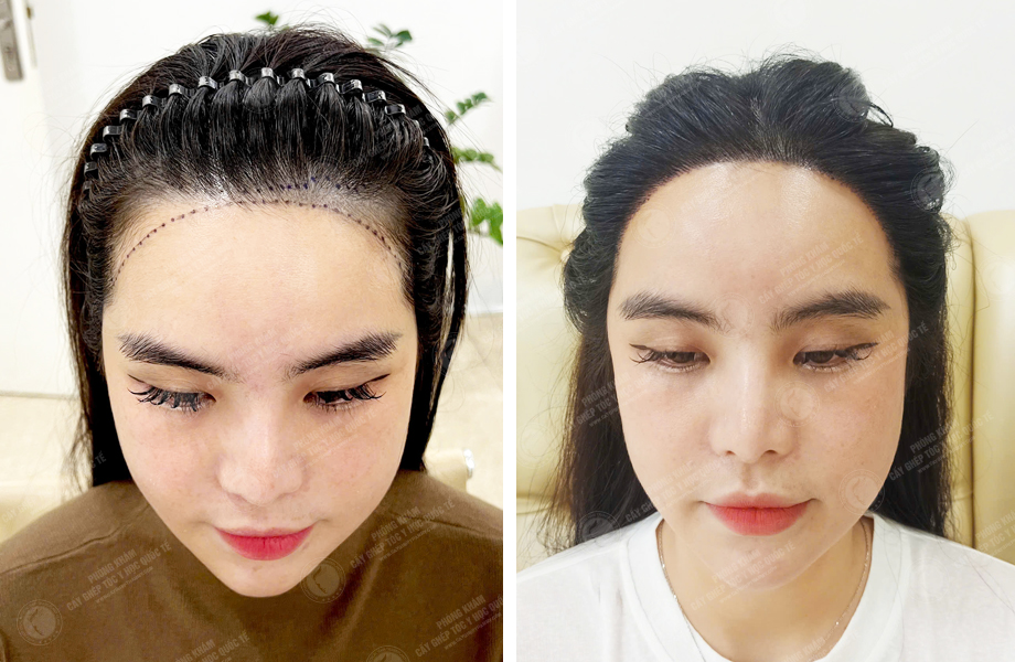  Huỳnh Bảo Ngân - Cấy tóc đường chữ M 1