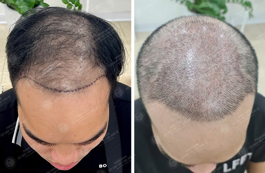  Nguyễn Văn Sơn - Cấy tóc đường chữ M 1