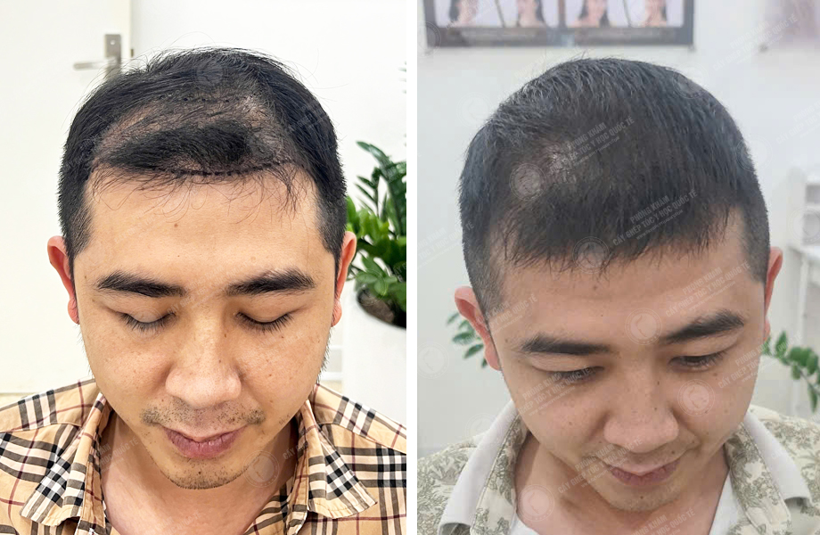  Lý Hoài Nam - Cấy tóc đường chữ M 1