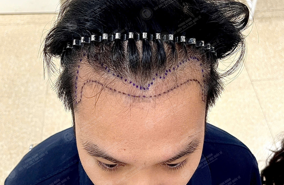 Phan Tùng Lâm - Cấy tóc đường chữ M 3