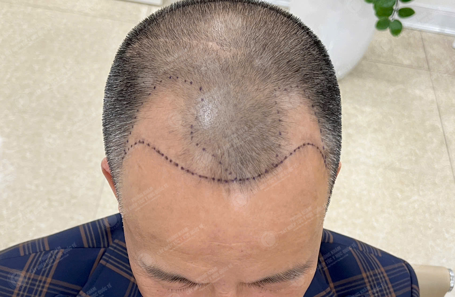 Trần Văn Toàn - Cấy tóc đường chữ M 3