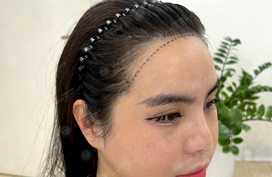 Huỳnh Bảo Ngân - Cấy tóc đường chữ M 3