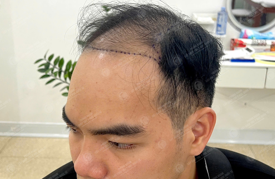 Nguyễn Văn Sơn - Cấy tóc đường chữ M 3