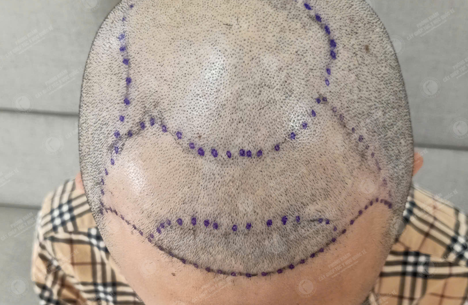 Lý Hoài Nam - Cấy tóc đường chữ M 3