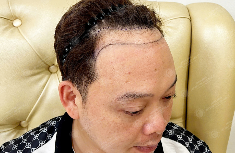 Nguyễn Quốc Đoàn - Cấy tóc đường chữ M 4