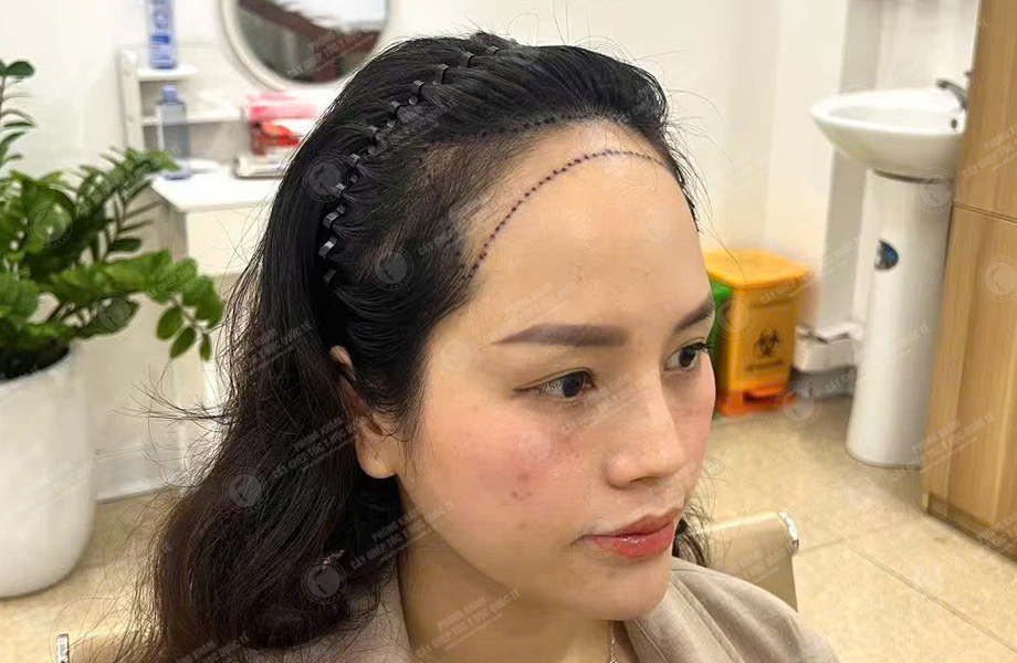 Nguyễn Thu Trà - Cấy tóc đường chữ M 3