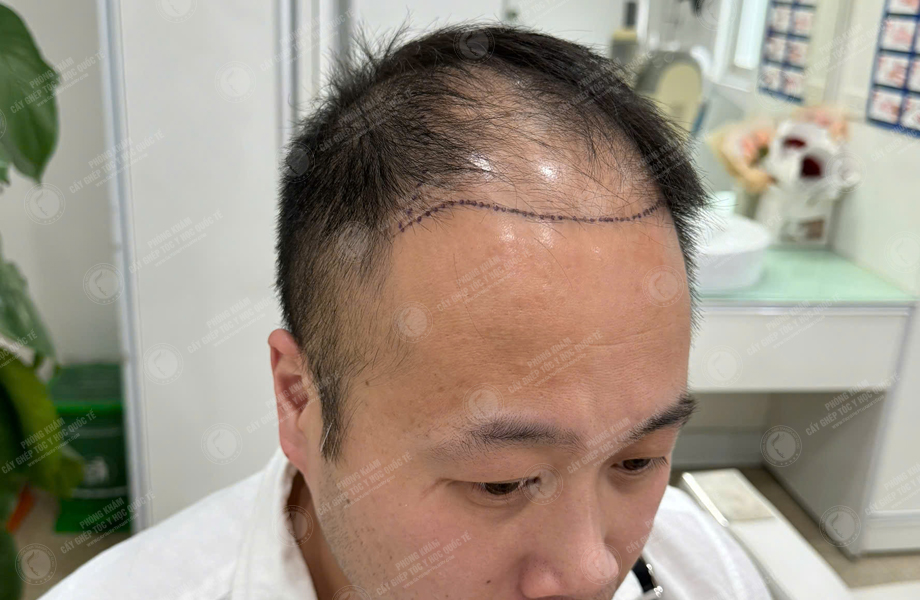 Nguyễn Duy Sơn - Cấy tóc đường chữ M 3
