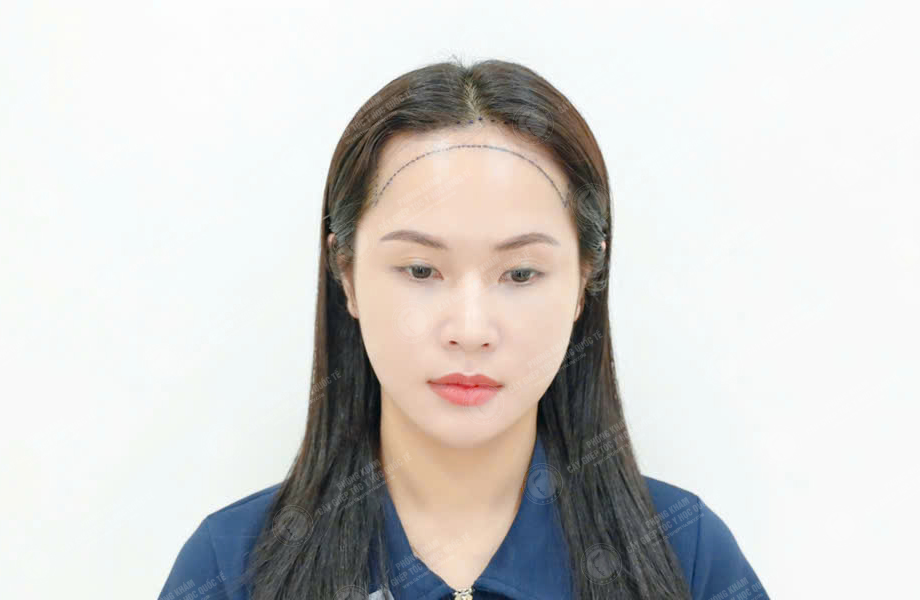 Hoàng Ngọc Linh - Cấy tóc đường chữ M 3