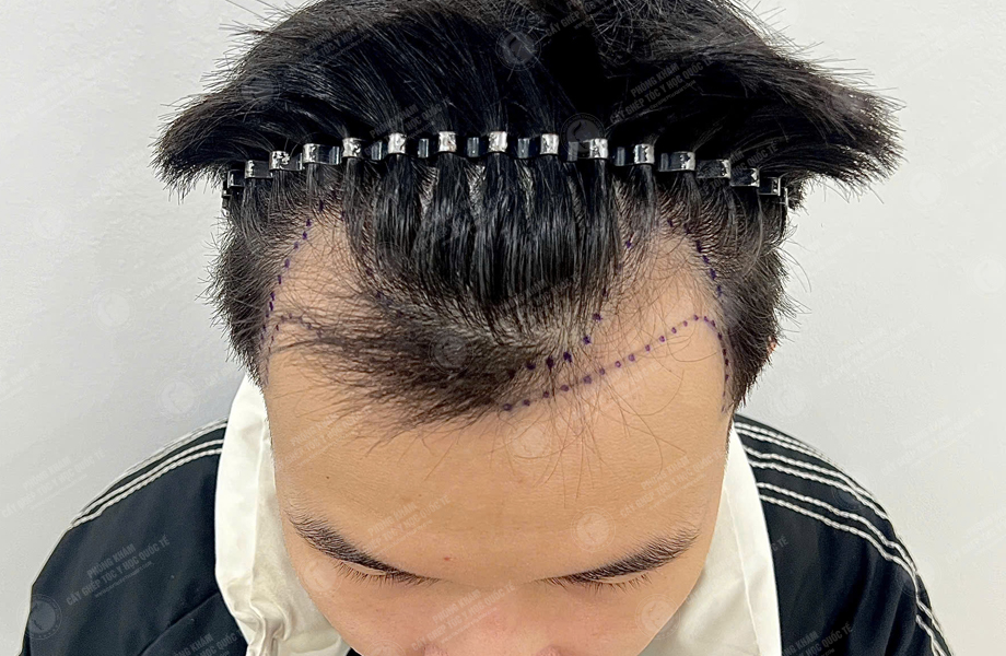 Trần Tuấn Hùng - Cấy tóc đường chữ M 3