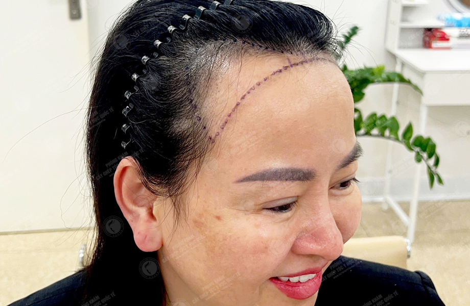 Nguyễn Thị Lan - Cấy tóc đường chữ M 3