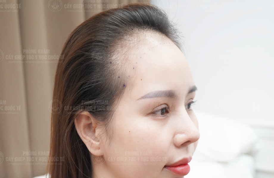 Nguyễn Nguyệt Nhi - Cấy tóc đường chữ M 3