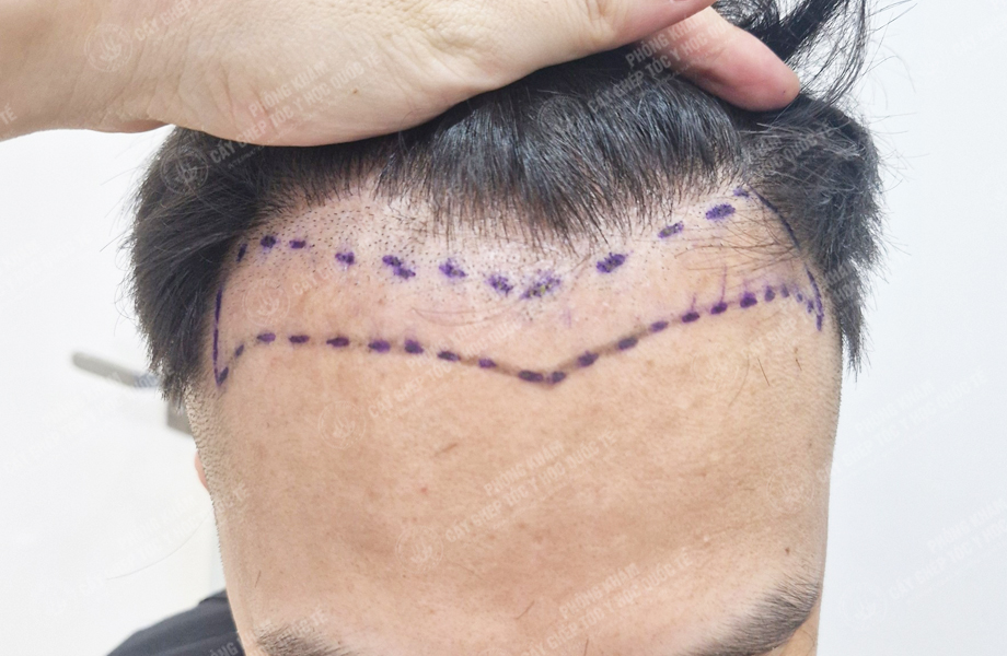 Vũ Quang Nam - Cấy tóc đường chữ M 3