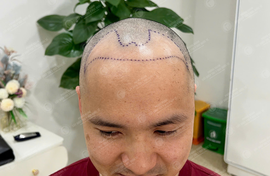 Nguyễn Văn Tùng - Cấy tóc đường chữ M 3